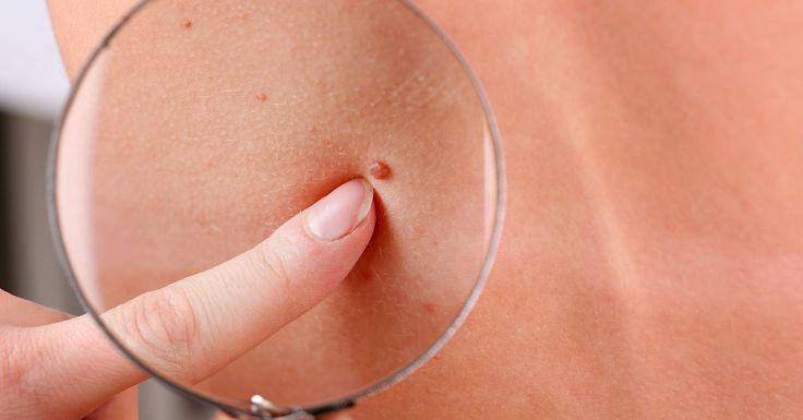 Cáncer de Piel Cancer de Piel