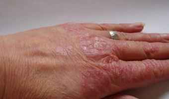 Psoriasis 2