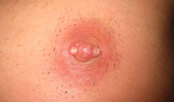 Absceso 2