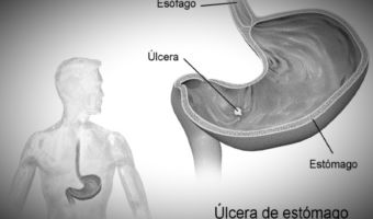 Úlcera 4