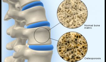 Osteoporosis 3