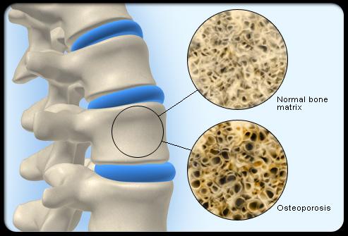 Osteoporosis 6