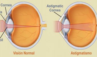 Astigmatismo 3