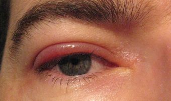 Blefaritis 3