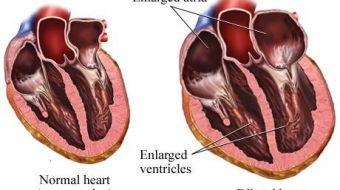 Cardiomegalia