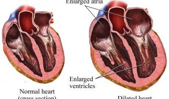Cardiomegalia 3
