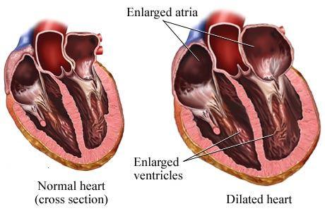Cardiomegalia 6