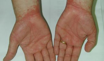 Dermatitis 3