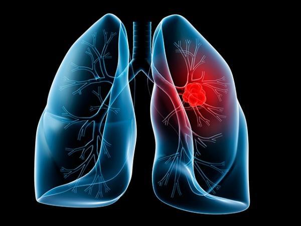 Cancer de pulmon