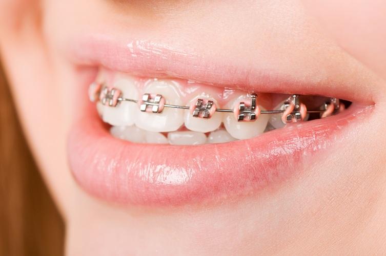 Qué es Brackets Definición, Significado y Concepto 2018