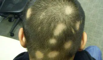 Alopecia 1
