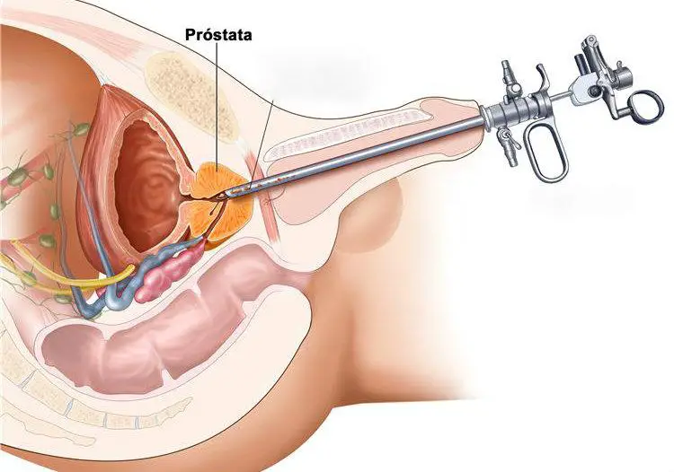 ubicacion de la prostata masculina)