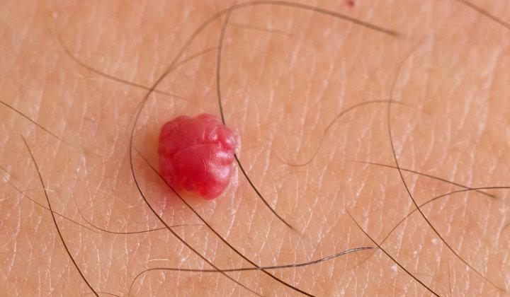 Angiomas