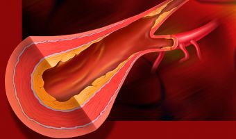 Aterosclerosis 2