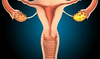 Endometriosis 2