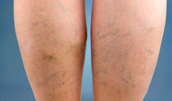 Varices 3