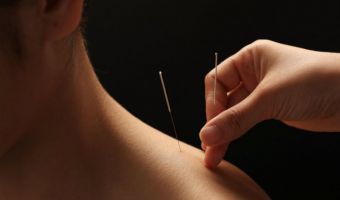 Acupuntura 3