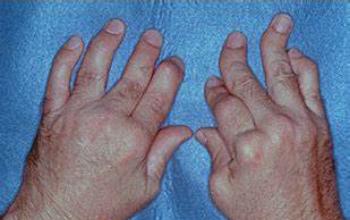 Fibromialgia - Artritis (diagnóstico diferencial)