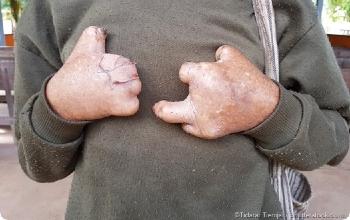 Lepra manos deformadas