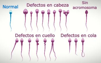 Espermatpzoide - Alteraciones en los espermatozoides
