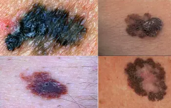 Cáncer de piel - Tipos del cáncer de piel