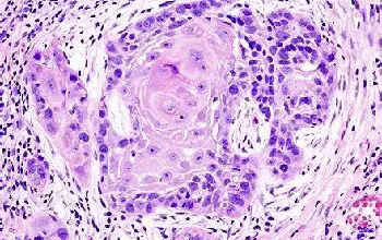 Cáncer de piel - Carcinoma de células escamosas