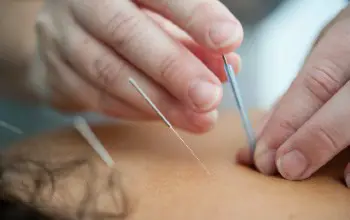 holistico - unas manos aplicando unas agujas de acupuntura