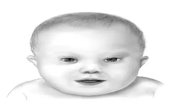Retrato del rostro de un bebe con síndrome de down en color gris en un fondo de color blanco